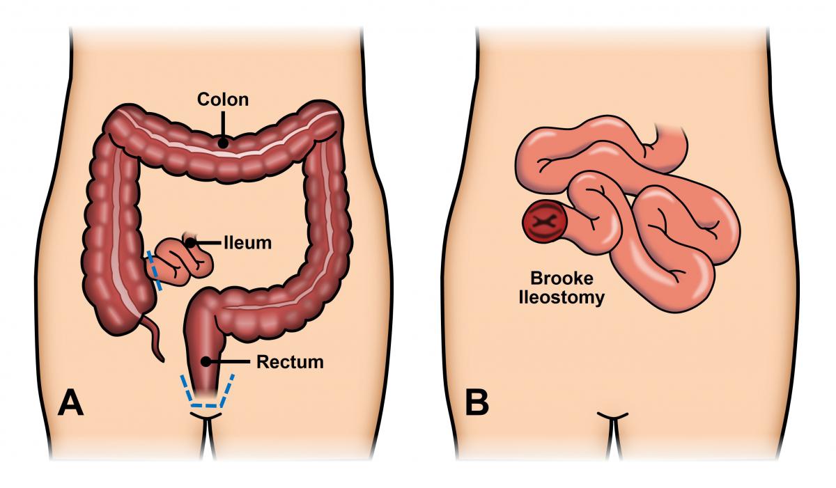 Colostrum can cause burning anus