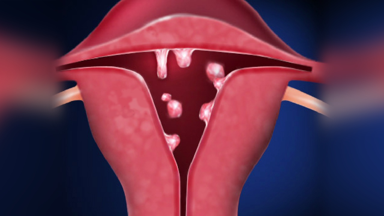 Полип эндометрия в шейке матки