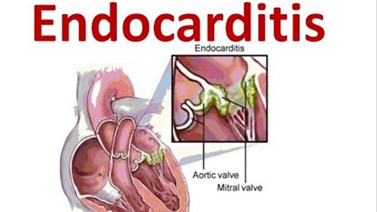 endokarditis