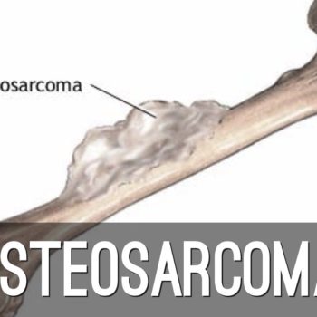 osteosarkoma