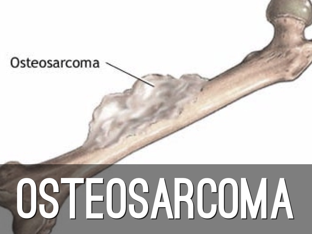 osteosarkoma